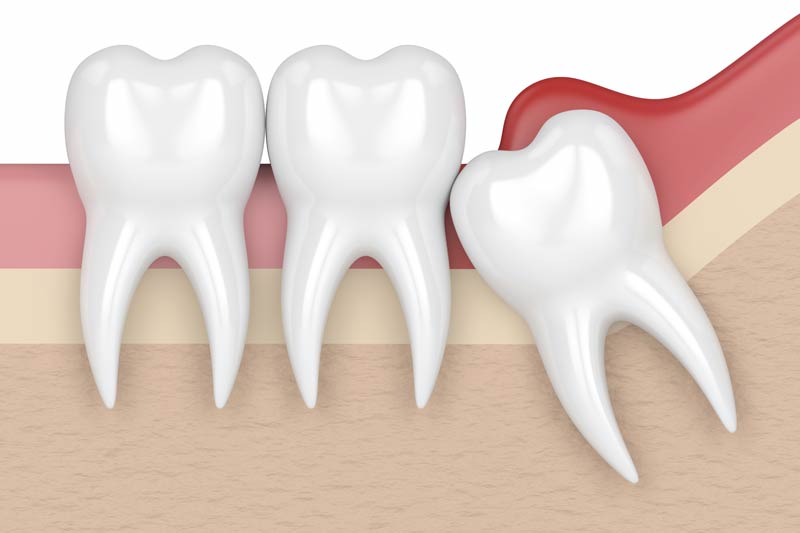 Wisdom Tooth Removal in San Diego
